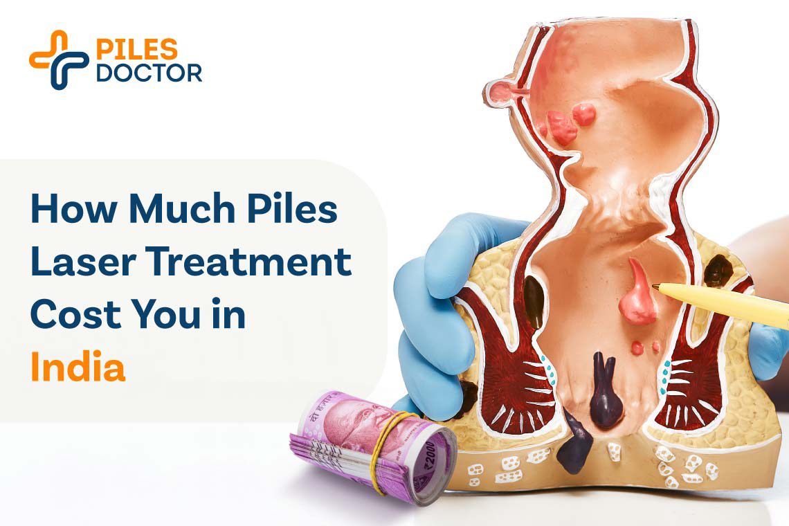 How Much Piles Laser Treatment Will Cost You Piles Doctor