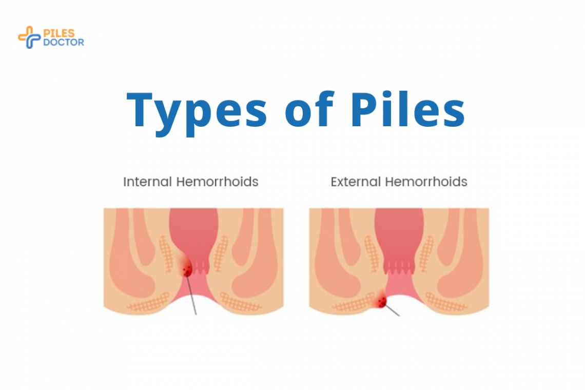 Type of Piles